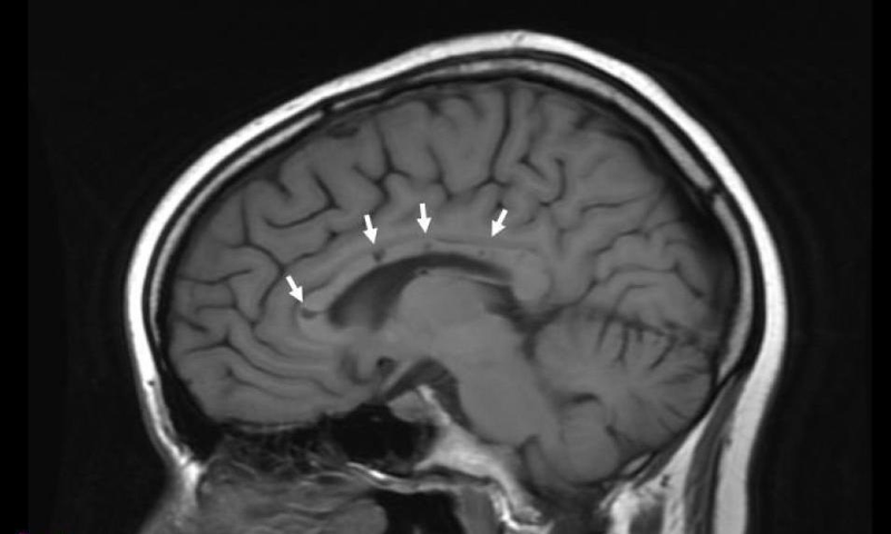 Cerebro afectado por síndrome de Susac. Foto: Wikipedia